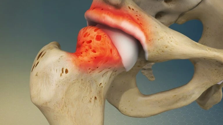 Femoroacetabular Impingement. hofteimpingement